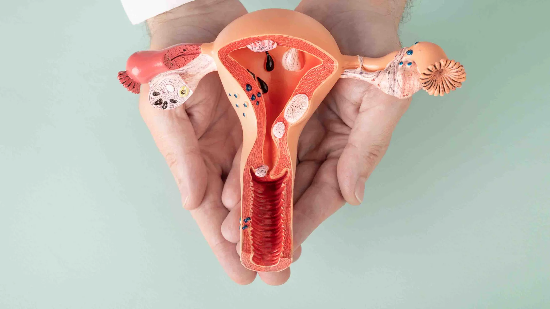 How To Overcome And Reason For Polycystic ovary Part 1